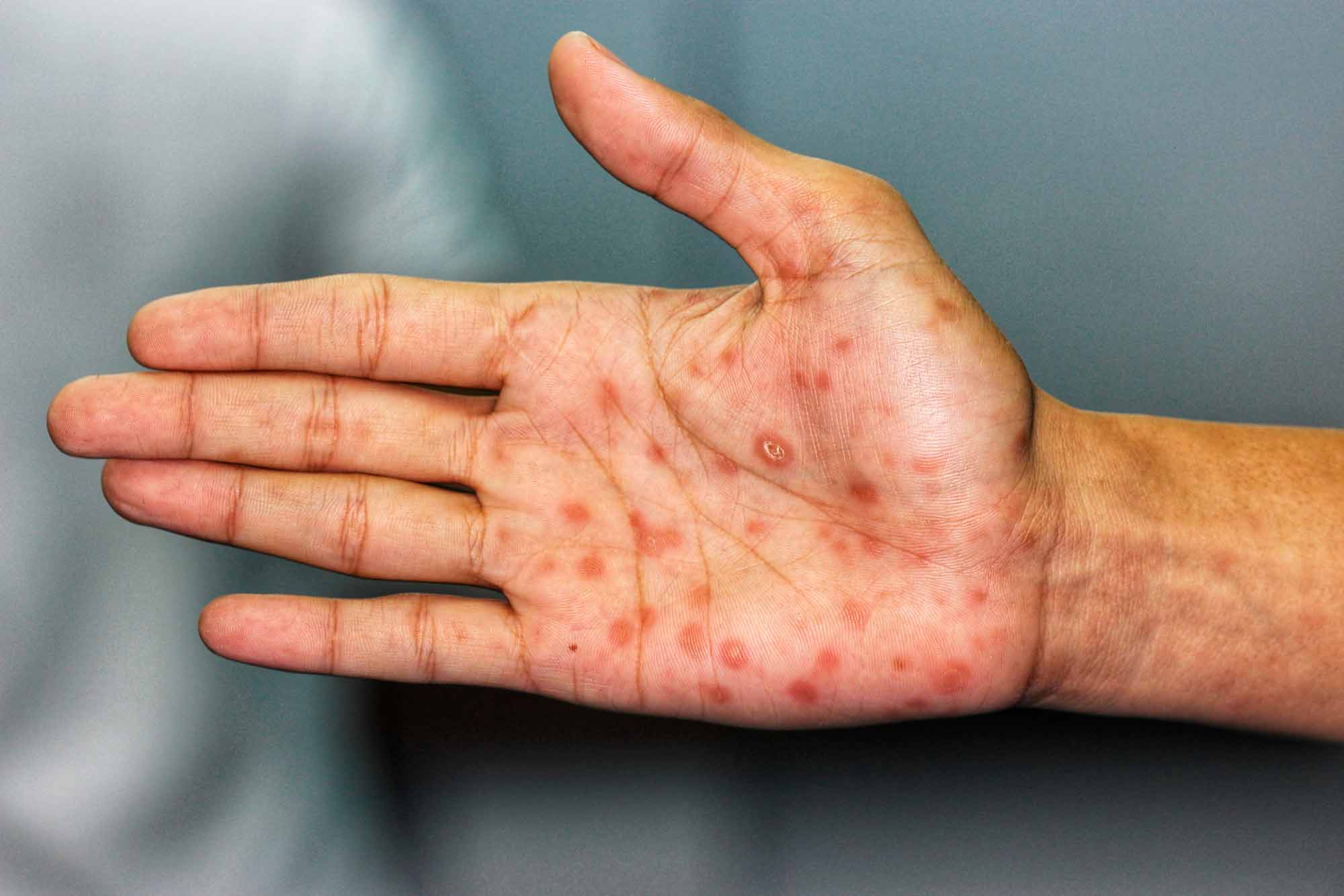 Sífilis: o que é, sinais e sintomas, quais os tipos e como tratar